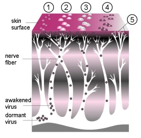 Course of shingles โ papule to vesicle to crust