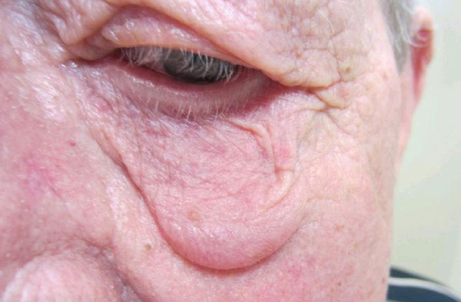 Rosacea โ facial presentation