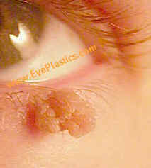 Papilloma skin lesion, Papillomatosis skin lesion Papillomas squamous lesion