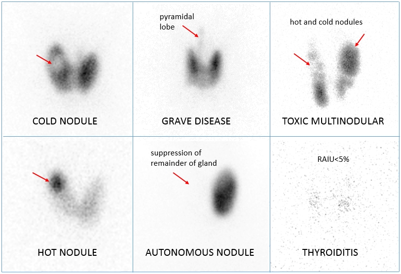 thyroid i123 update scan