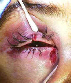 This photo below shows a patient who was hit in their right eye with a fist and who sustained a canalicular laceration.