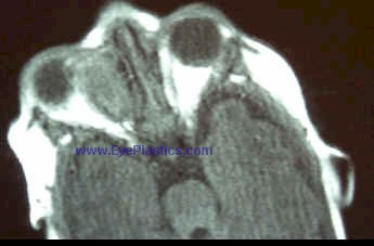 Large, orbital capillary hemangioma - Left Orbit