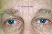 Pre-Operative photograph: Brow Ptosis, excess skin: 1 month