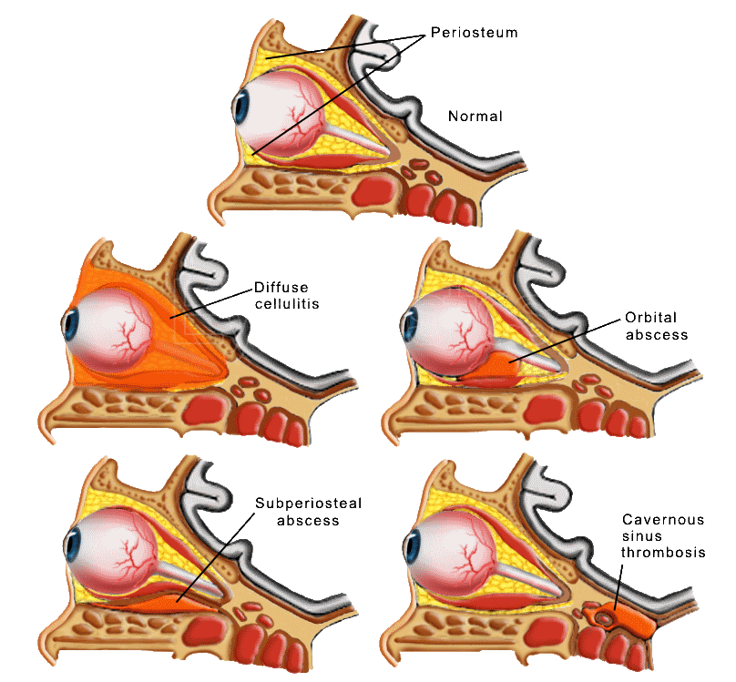Cellulitis   Orbital Presptal